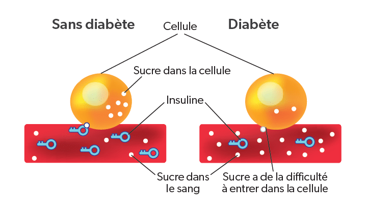 Quest Ce Que Le Diab Te Diab Te Qu Bec